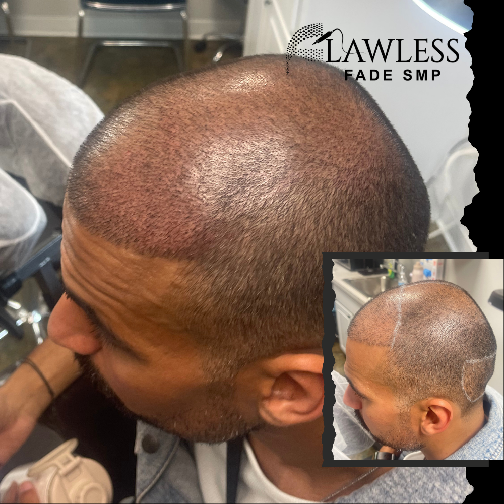 hairline restoration hairline restoration