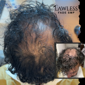 hairline restoration