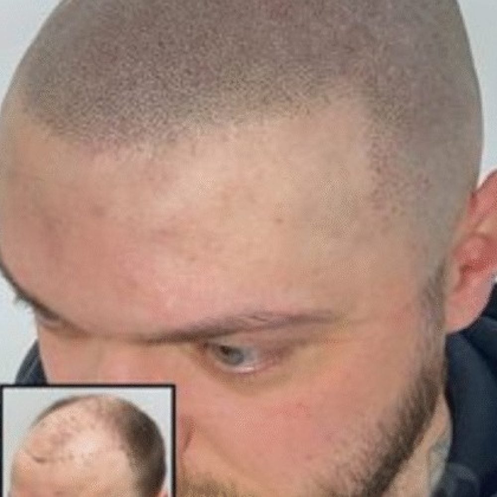alopecia